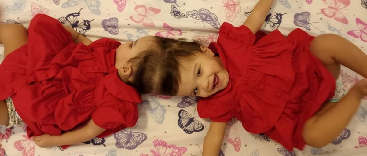 As gêmeas siamesas Allana e Mariah foram separadas após cirurgia que teve 25 horas de duração