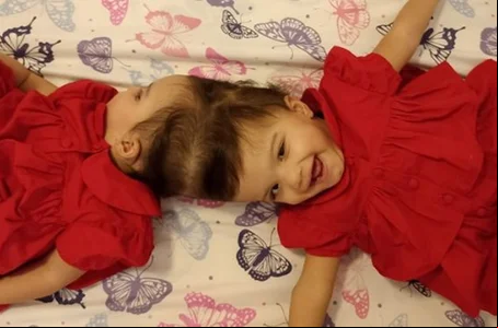 As gêmeas siamesas Allana e Mariah foram separadas após cirurgia que teve 25 horas de duração